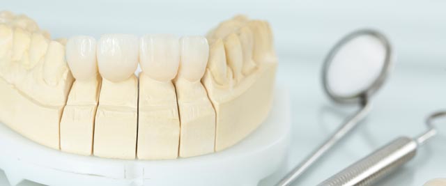 Model of dental implant