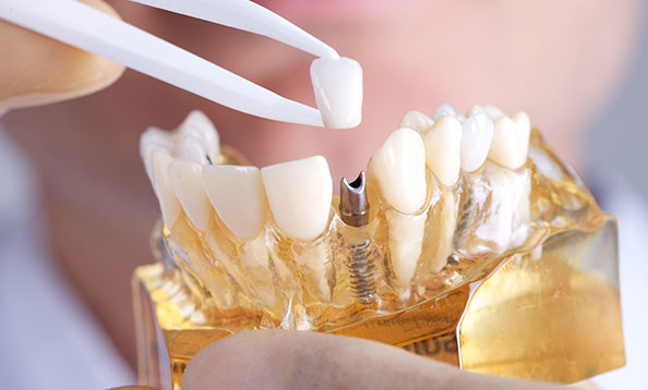 Dental Implants