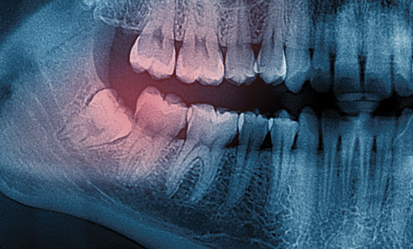 Wisdom Teeth Extraction